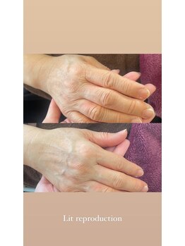 コモア(COMOA)/年齢の出やすい手にも打ち込み