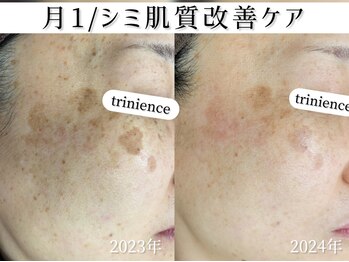 トリニエンス 新宿店(TRINIENCE)/40代/シミケア/肌代謝ケア