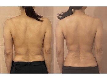 ゆう/1度でたるみスッキリ！