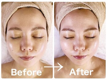 ソウ 新宿(SOU)/リフトUPで人気の筋膜リフト☆