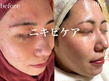 ネオリー(neorii)/ハーブピーリング　ニキビケア