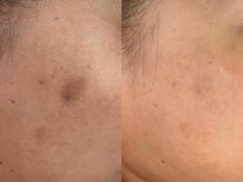 サクラ 本厚木駅前店(SAKURA)/本厚木シミケア/伊勢店シミケア