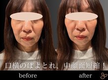 チョコバリ 渋谷店(chocobari)/小顔×リフトアップ(美容鍼)40代