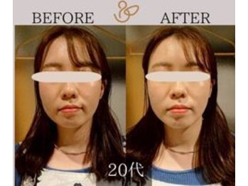 チョコバリ 新宿店(chocobari)/小顔×リフトアップ(美容鍼)20代