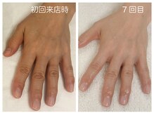 キレイテ 福岡天神店/40代/7回目【博多ハンドケア】