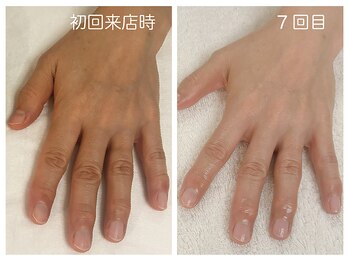 キレイテ 福岡天神店/40代/7回目【博多ハンドケア】