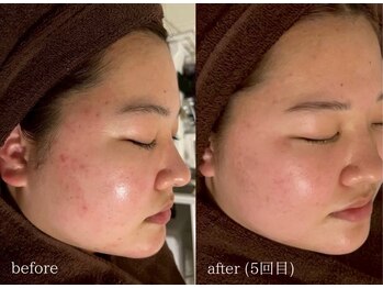 エト(eto.)/赤ニキビ