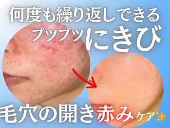 ハル(HARU.)の写真/【ぴったりメニュー発見☆】肌診断で選ぶ最適ケア★潤いと透明感のある、毛穴の目立ちにくい理想の美肌へ♪