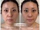 サロンドモモ(SALON de MOMO)の写真/何しても変わらなかった方へ｜1回で変化する小顔リフト