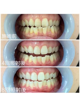 ホワイトニングサロン 京都烏丸店/ホワイトニング施術例