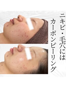 キー(kii)/カーボンピーリング