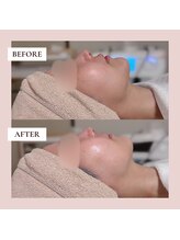 ミーティス/インディバで美しい横顔へ♪