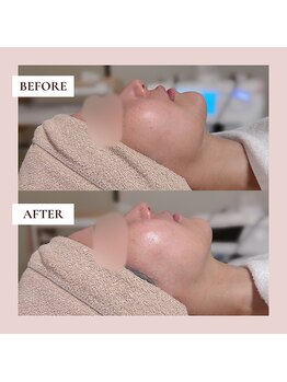 ミーティス/インディバで美しい横顔へ♪