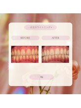 プラスビー 2号店(+b)/ホワイトニングビフォーアフター