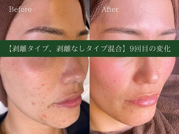 エミルカ 土岐店(EMILUCA)/ニキビ/色素沈着