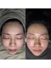 【ツヤ肌派に超絶オススメ♪】お顔の産毛バイバイ☆FullフェイスWax/6000円