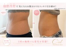 シエル(Ciel)の雰囲気（１度の施術でスッキリお腹！脂肪冷却４カップです♪）