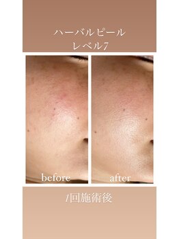 リュミエール(LUMIERE)/ハーバルピールレベル7