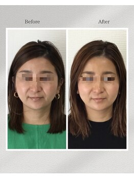 トータルトリートメント優鍼灸院/美容鍼３回の効果