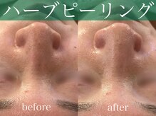 モア 星ヶ丘店(MORE)/ハーブピーリング