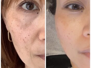 ランティル(l’until)の写真/たるんだ頬、ほうれい線、フェイスライン、目の下のたるみを引き上げ改善。若見えするお肌に。