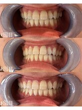 スマイルプライベートビューティサロン(Smile)/セルフホワイトニング