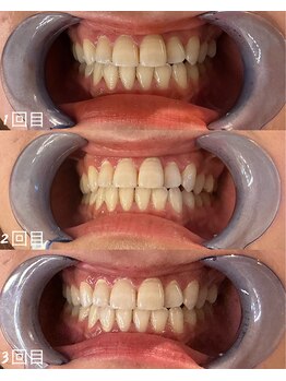 スマイルプライベートビューティサロン(Smile)/セルフホワイトニング