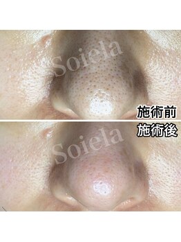 ソワラ(Soiela)の写真/毛穴レスなクリア肌へ☆ハーブピーリングで実感!フェイシャルで理想の透明感♪