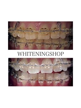 ホワイトニングショップ 徳島店/Before&After美白ホワイトニング