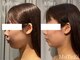 モテキ 表参道店(MoTeKi)の写真/【韓国発☆最新次世代マイクロ波リフト】ダウンタイムなし！即日で理想なフェイスラインに♪