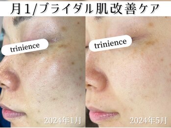 トリニエンス 新宿店(TRINIENCE)/20代/パーソナル改善ケア