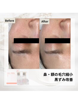 ルアナ(Luana)/ララピールの効果★