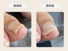 ルポ 伊勢/巻き爪ケア