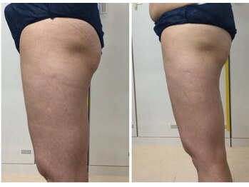 アヤエステティックサロン 綱島店(AYA)の写真/【最新マシンで太ももヒップ脂肪燃焼】憧れのくびれとすき間を叶える美脚へ！！
