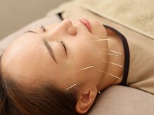 ハリノヒ 大阪院/しわ・ほうれい線引き上げ美容鍼