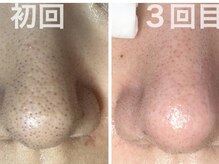 スウ(su:)/3回目で別人級の毛穴に！