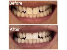 ご家族やお友達と一緒にホワイトニングを受けることもできます♪