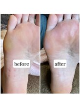 TonaLino by ルカポン/足裏の角質ケア