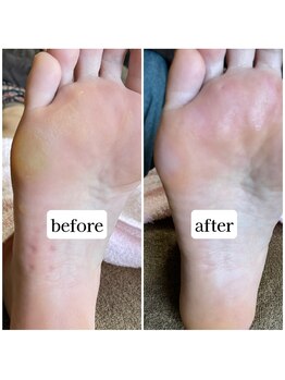 TonaLino by ルカポン/足裏の角質ケア