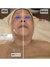 【2・3回目限定◎戻らない上向き肌へ】二重あご・たるみラフォス集中ケア