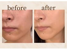 アンバー 恵比寿(AMBER)/お顔のハーブピーリング