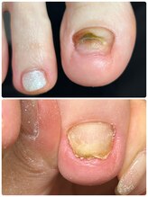 ココ ネイル サロン アンドスクール(COCO.NAIL SALON＆SCHOOL)/トラブルフットケア