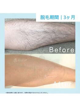 メンズクリア シーモール下関店/【メンズクリア】お客様の施術例