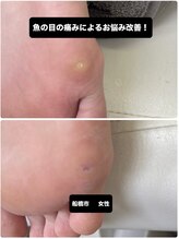 巻き爪じゅん 千葉駅前店/魚の目の痛み改善の専門施術