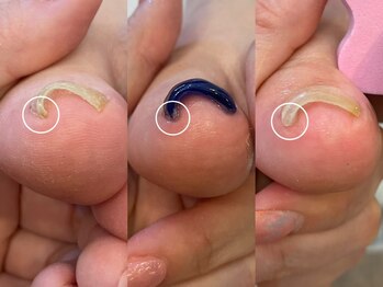 キラネイル アンド アイラッシュ by World Beauty(KIRA)/新潟巻爪補正