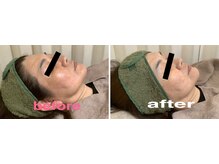 リマインド(ReMind)/日焼け