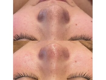 リ クリニカル ラボ(Re clinical Labo)/毛穴開き改善