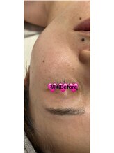 リアスキン(Lia skin)/毛穴、ほうれい線でお悩みの方