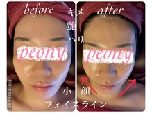 ピオニー(PEONY)/小顔 毛穴 美白 ブライダル