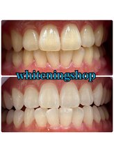 ホワイトニングショップ 吉祥寺店/BEFORE ＆ AFTER